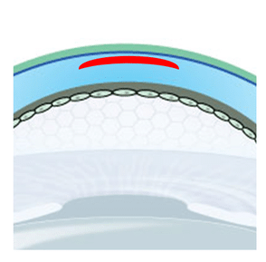 Schematische doorsnede van het hoornvlies met de positie van het lenticule bij SmartSight.